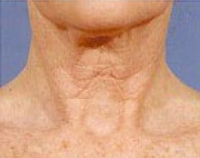 Fraxel Laser Before & After Patient #2090