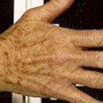 Fraxel Laser Before & After Patient #2089