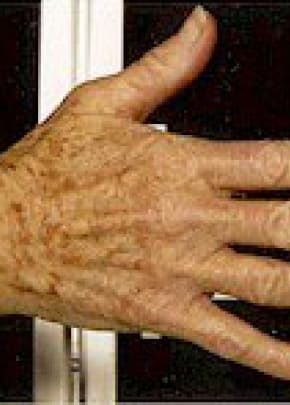 Fraxel Laser Before & After Patient #2089