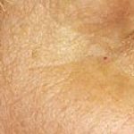 Fraxel Laser Before & After Patient #2078