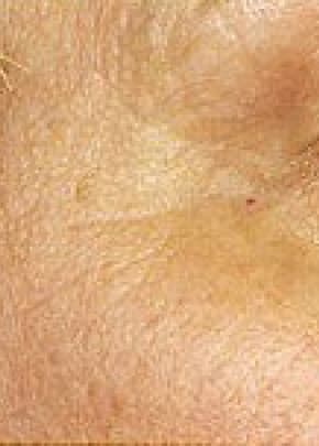 Fraxel Laser Before & After Patient #2078