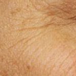 Fraxel Laser Before & After Patient #2078