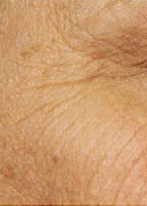 Fraxel Laser Before & After Patient #2078