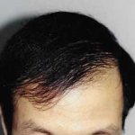 Hair Transplant Before & After Patient #2053