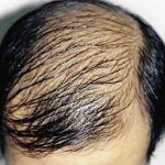 Hair Transplant Before & After Patient #2053