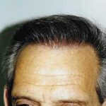 Hair Transplant Before & After Patient #2052