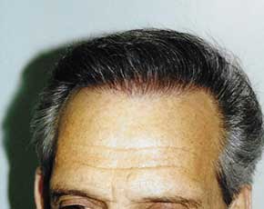 Hair Transplant Before & After Patient #2052