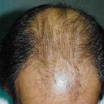 Hair Transplant Before & After Patient #2052