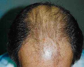 Hair Transplant Before & After Patient #2052