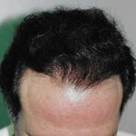 Hair Transplant Before & After Patient #2051
