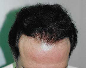Hair Transplant Before & After Patient #2051