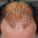 Hair Transplant Before & After Patient #2051