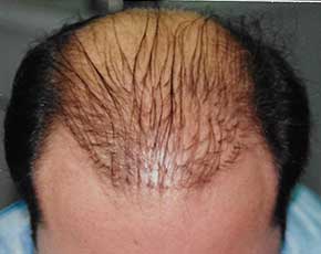 Hair Transplant Before & After Patient #2051
