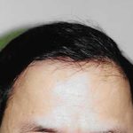 Hair Transplant Before & After Patient #2050