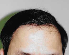 Hair Transplant Before & After Patient #2050