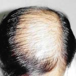 Hair Transplant Before & After Patient #2050