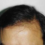 Hair Transplant Before & After Patient #2049