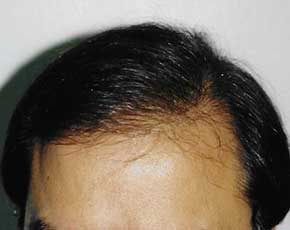 Hair Transplant Before & After Patient #2049