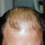 Hair Transplant Before & After Patient #2049