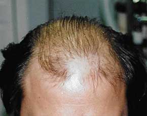 Hair Transplant Before & After Patient #2049