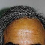 Hair Transplant Before & After Patient #2048