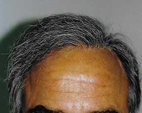 Hair Transplant Before & After Patient #2048