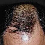 Hair Transplant Before & After Patient #2048