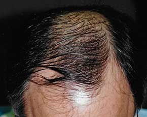 Hair Transplant Before & After Patient #2048
