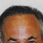 Hair Transplant Before & After Patient #2047