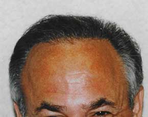Hair Transplant Before & After Patient #2047