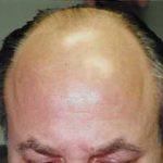 Hair Transplant Before & After Patient #2047