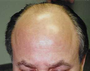 Hair Transplant Before & After Patient #2047