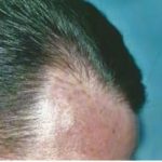Hair Transplant Before & After Patient #2046