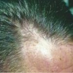 Hair Transplant Before & After Patient #2046