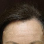 Hair Transplant Before & After Patient #2045