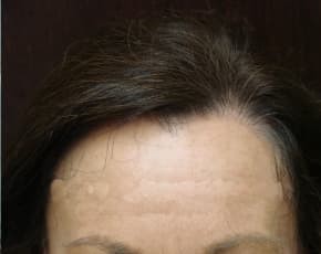 Hair Transplant Before & After Patient #2045