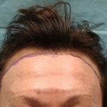 Hair Transplant Before & After Patient #2045