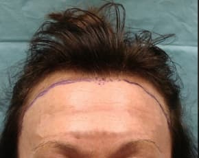 Hair Transplant Before & After Patient #2045