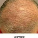Hair Transplant Before & After Patient #2044
