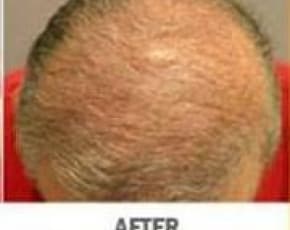 Hair Transplant Before & After Patient #2044