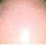 Hair Transplant Before & After Patient #2044