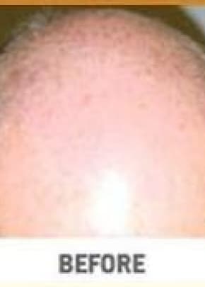 Hair Transplant Before & After Patient #2044