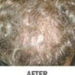 Hair Transplant Before & After Patient #2043