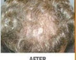 Hair Transplant Before & After Patient #2043