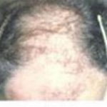 Hair Transplant Before & After Patient #2043