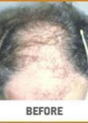 Hair Transplant Before & After Patient #2043