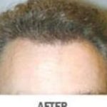Hair Transplant Before & After Patient #2042