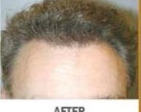 Hair Transplant Before & After Patient #2042