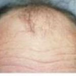 Hair Transplant Before & After Patient #2042