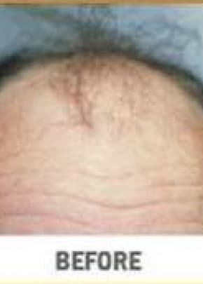 Hair Transplant Before & After Patient #2042